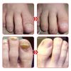 NailHelper Ingrowth Toenail Correction Treatment Oil